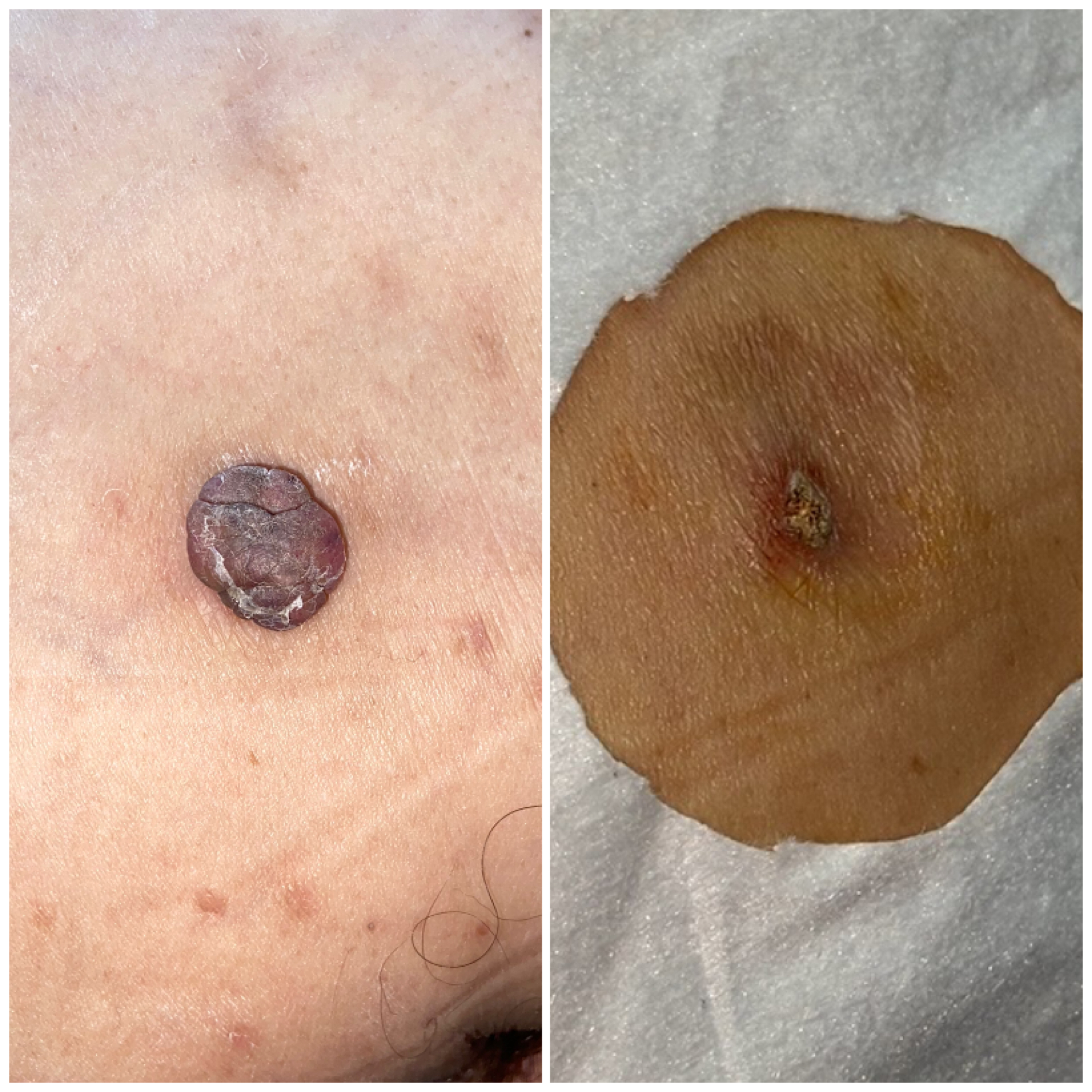 Skin Tags