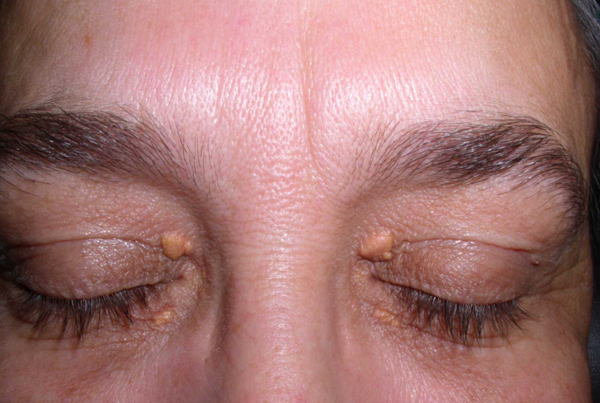 Xanthelasma