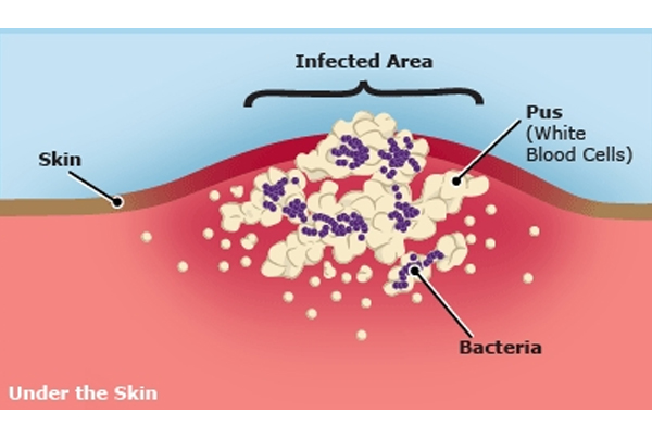 Incision and Drainage of Small Abscess (Pus Collection)