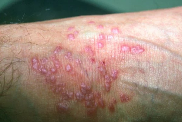 Biopsy Skin / Oral or Genital Mucosa - Punch/Excision/Incision Method