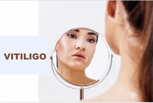 Stable Vitiligo