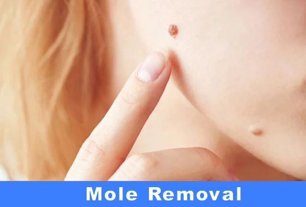 Moles (Melanocyticnevus)
