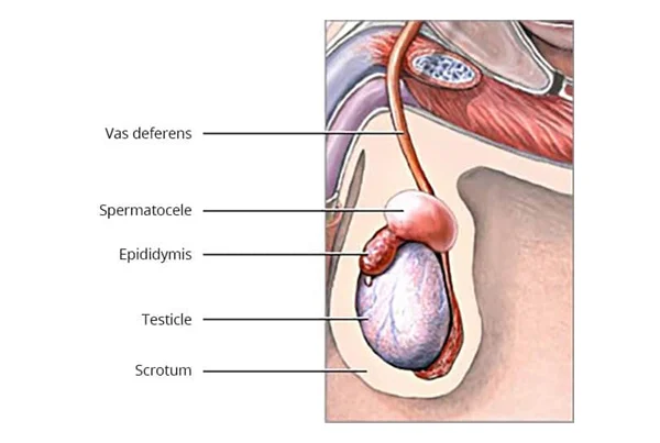 Scrotum Cyst Removal