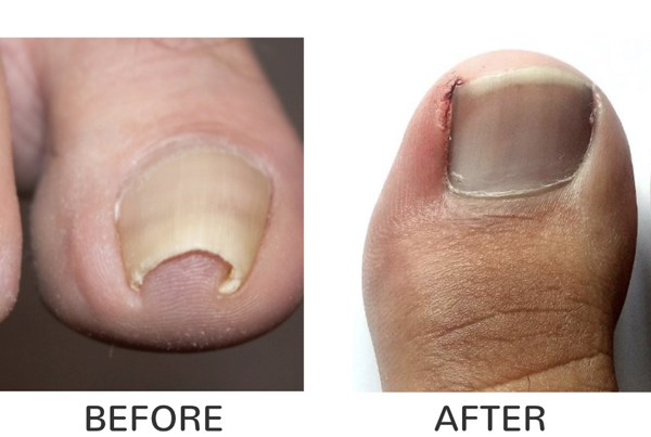 Nail Surgery